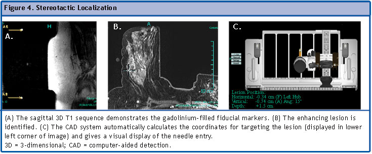 Clip migration after stereotactic vacuum-assisted breast biopsy with the  patient in the decubitus position