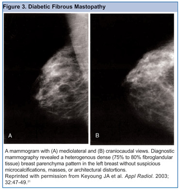 Mastitis Treatment Antibiotics Emedicine